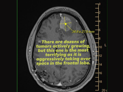 Снимок с магнитно-резонансной томографии Майкла Принка, выложенный его женой в социальных сетях