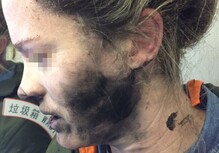Ожоги на лице девушки, которая использовала наушники Beats (Изображение: Neowin)